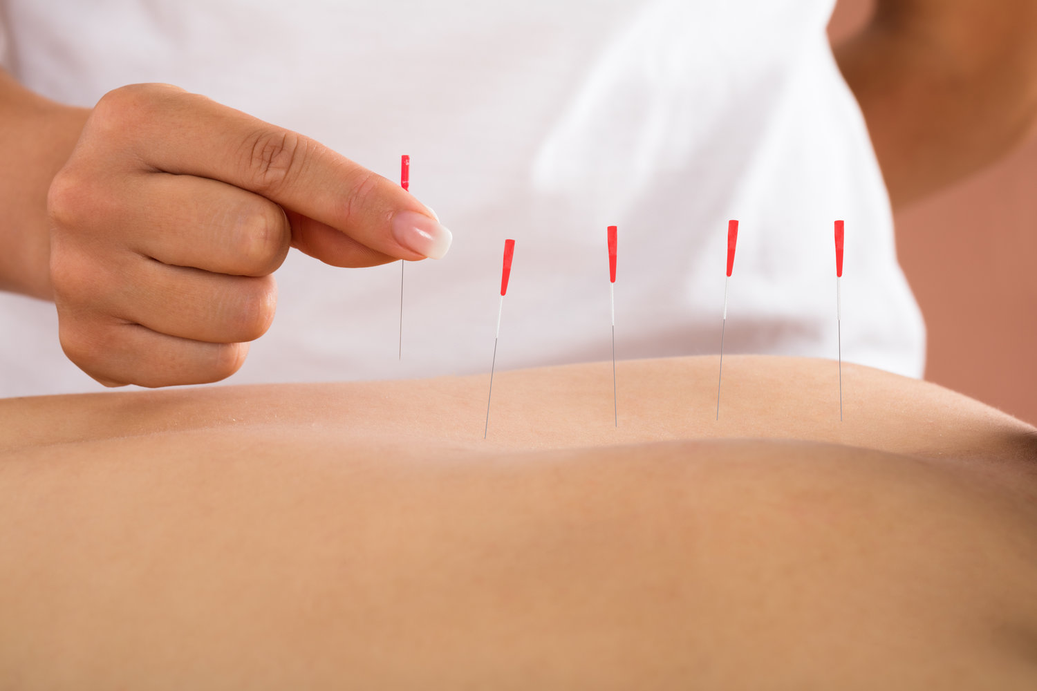 Person Receiving Acupuncture Treatment